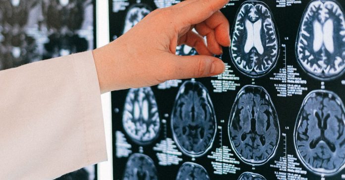Alzheimer'da 110 Yıllık Yanlış: Gizli Tetikleyici Yakalandı