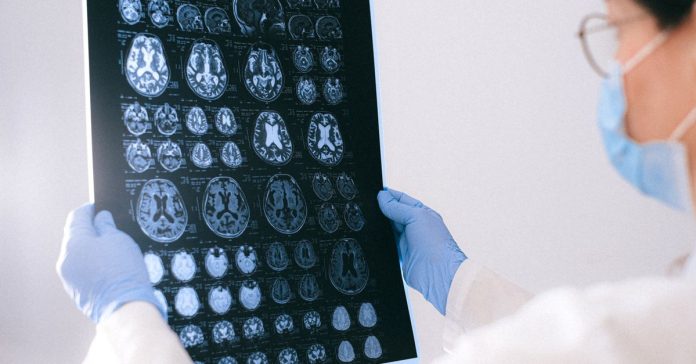 Alzheimer'da Mucize Gelişme: Semptomlar Tersine Döndü!
